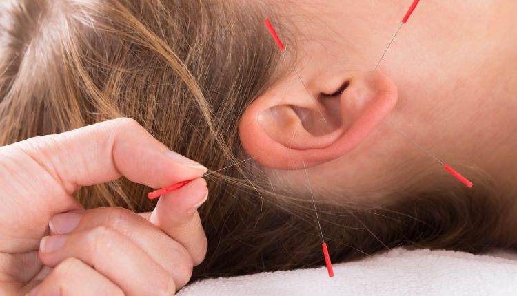 Acupuncture